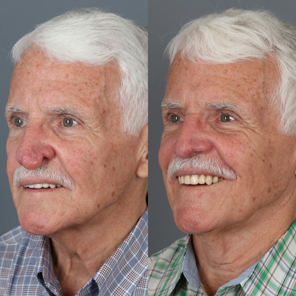 Rhinophyma Before & After Gallery - Patient 123046239 - Image 2