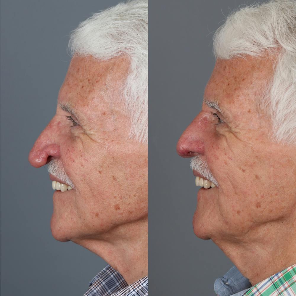 Rhinophyma Before & After Gallery - Patient 123046239 - Image 1