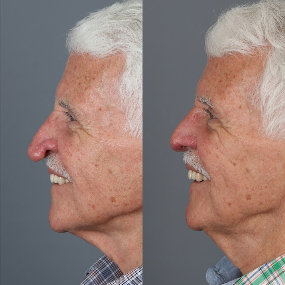 Rhinophyma