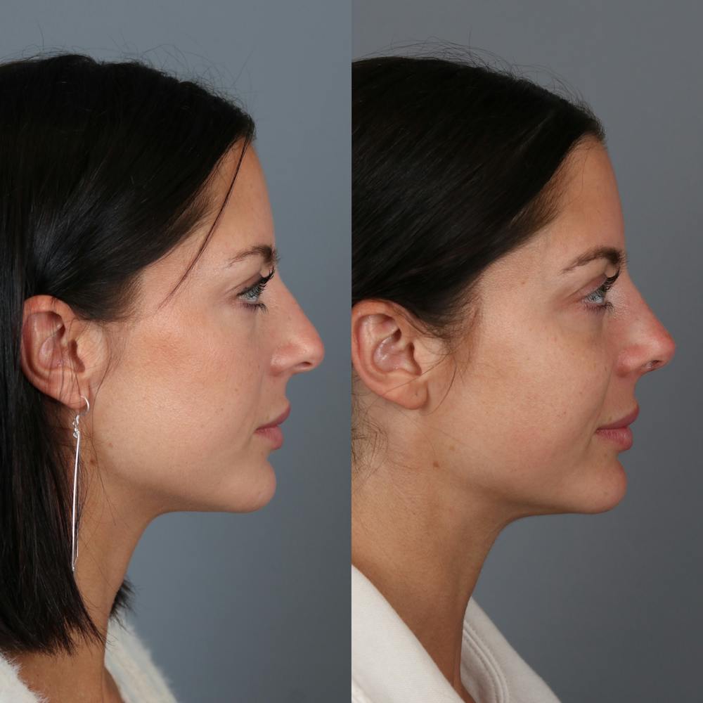 Rhinoplasty Before & After Gallery - Patient 123046243 - Image 1