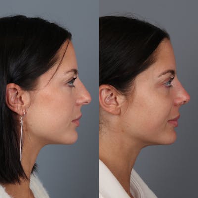 Rhinoplasty Before & After Gallery - Patient 123046243 - Image 2