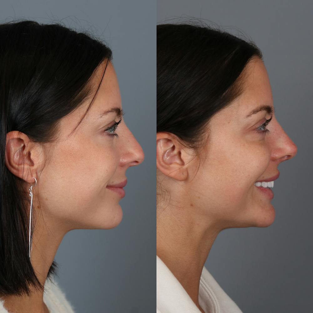 Rhinoplasty Before & After Gallery - Patient 123046243 - Image 3