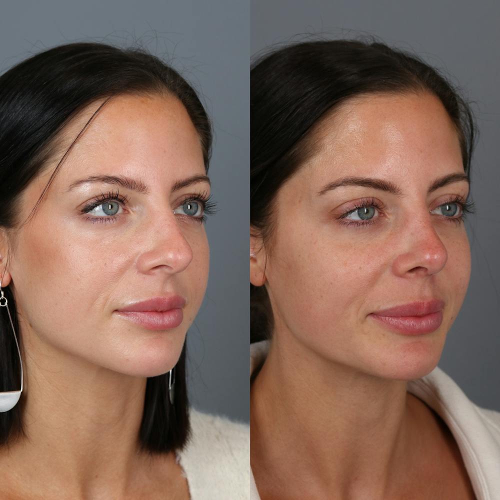 Rhinoplasty Before & After Gallery - Patient 123046243 - Image 4