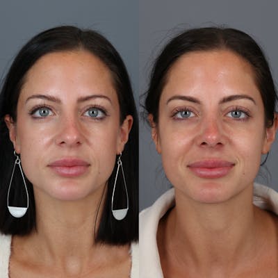 Rhinoplasty Before & After Gallery - Patient 123046243 - Image 2