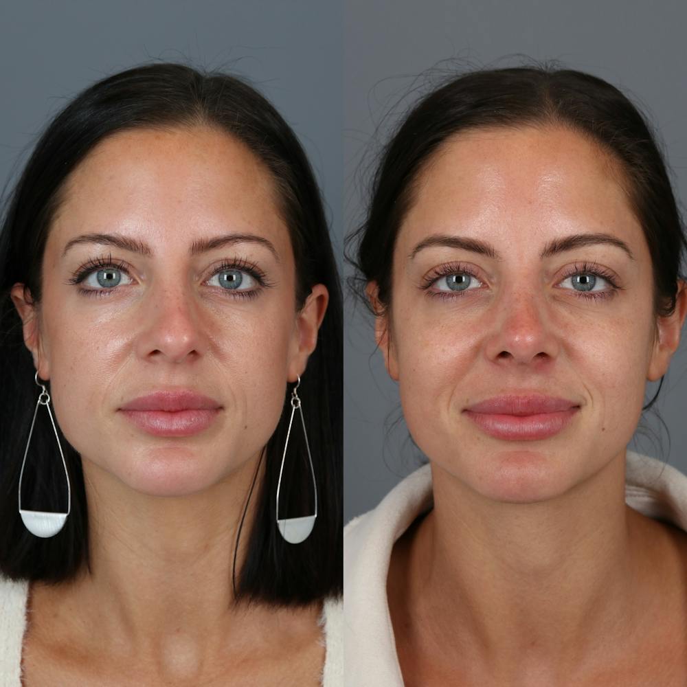 Rhinoplasty Before & After Gallery - Patient 123046243 - Image 2