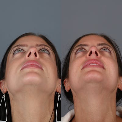 Rhinoplasty Before & After Gallery - Patient 123046243 - Image 6