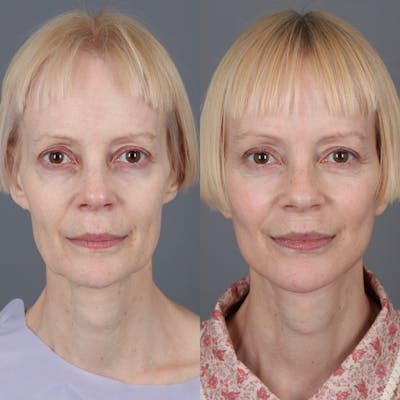 Facelift Before & After Gallery - Patient 123176050 - Image 1