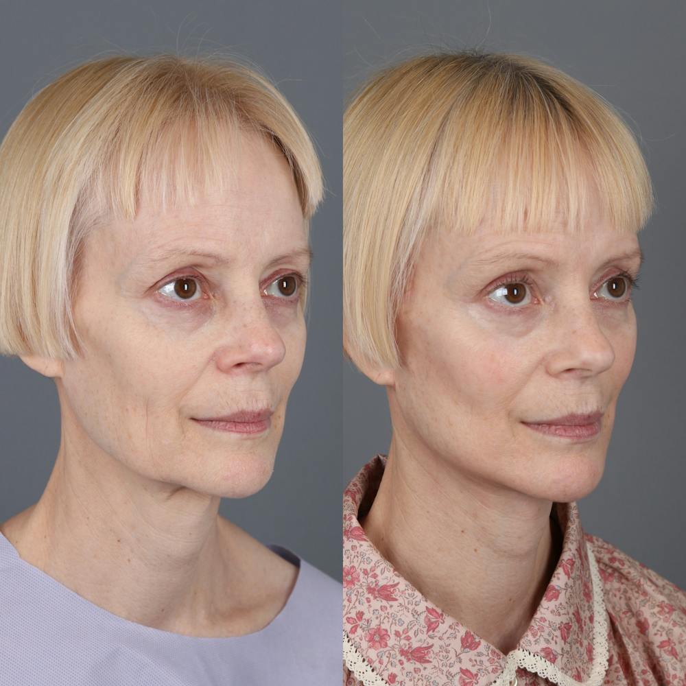 Face & Neck Lift Before & After Gallery - Patient 123176050 - Image 1