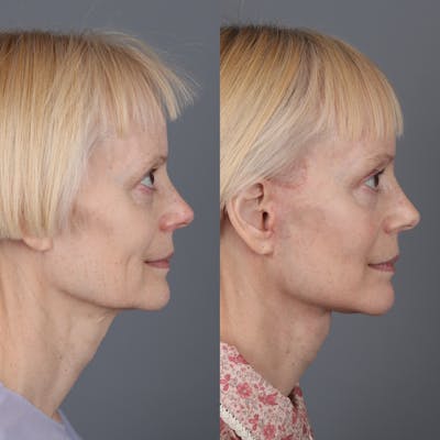 Face & Neck Lift Before & After Gallery - Patient 123176050 - Image 4