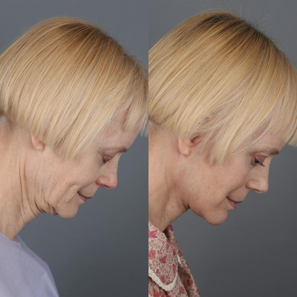 Face & Neck Lift Before & After Gallery - Patient 123176050 - Image 3