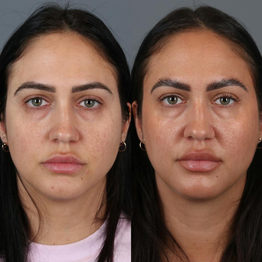 Buccal Fat Removal Before & After Gallery - Patient 123430789 - Image 1