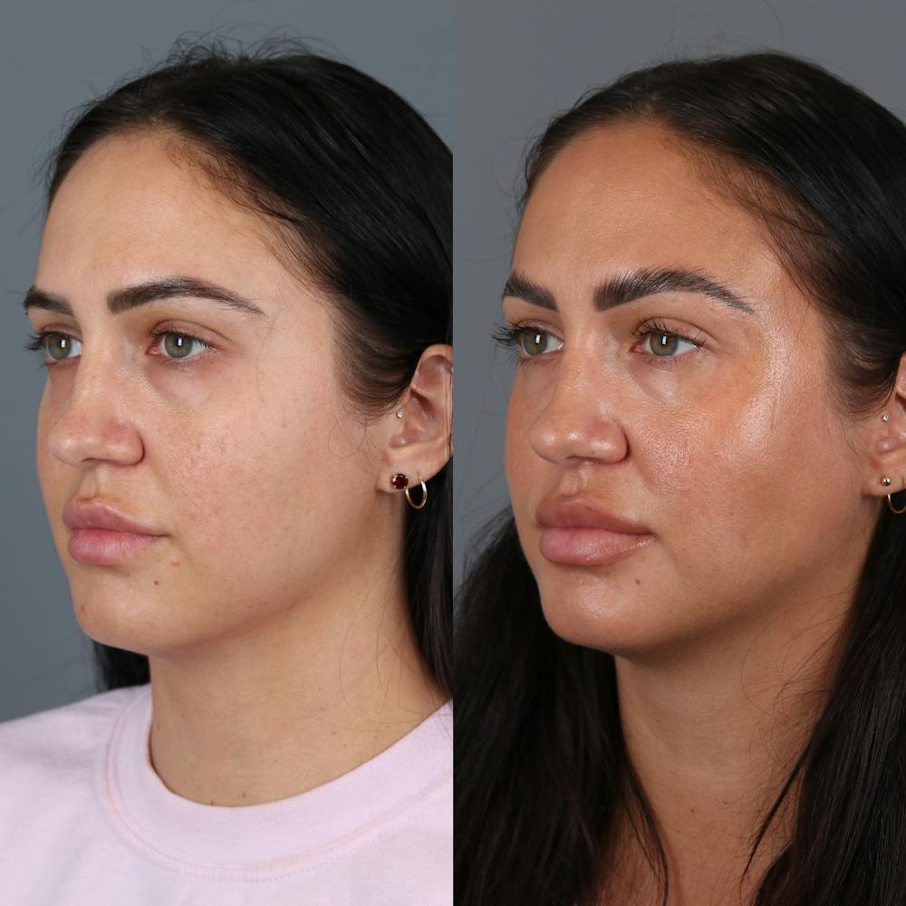 Buccal Fat Removal Before & After Gallery - Patient 123430789 - Image 2