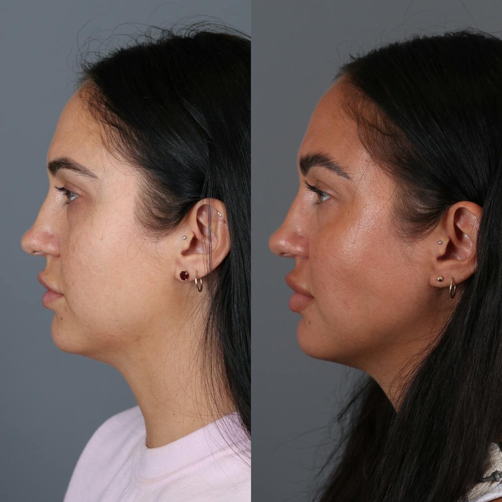 Buccal Fat Removal Before & After Gallery - Patient 123430789 - Image 3