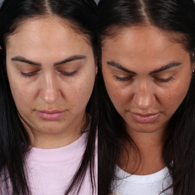 Buccal Fat Removal Before & After Gallery - Patient 123430789 - Image 4