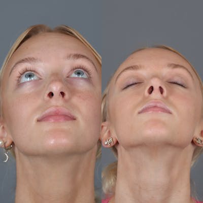 Rhinoplasty Before & After Gallery - Patient 123430792 - Image 6