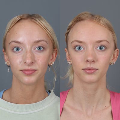 Rhinoplasty Before & After Gallery - Patient 123430792 - Image 1