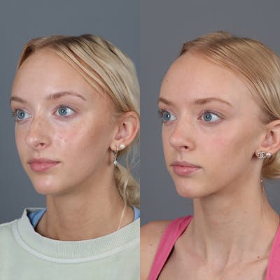 Rhinoplasty Before & After Gallery - Patient 123430792 - Image 2