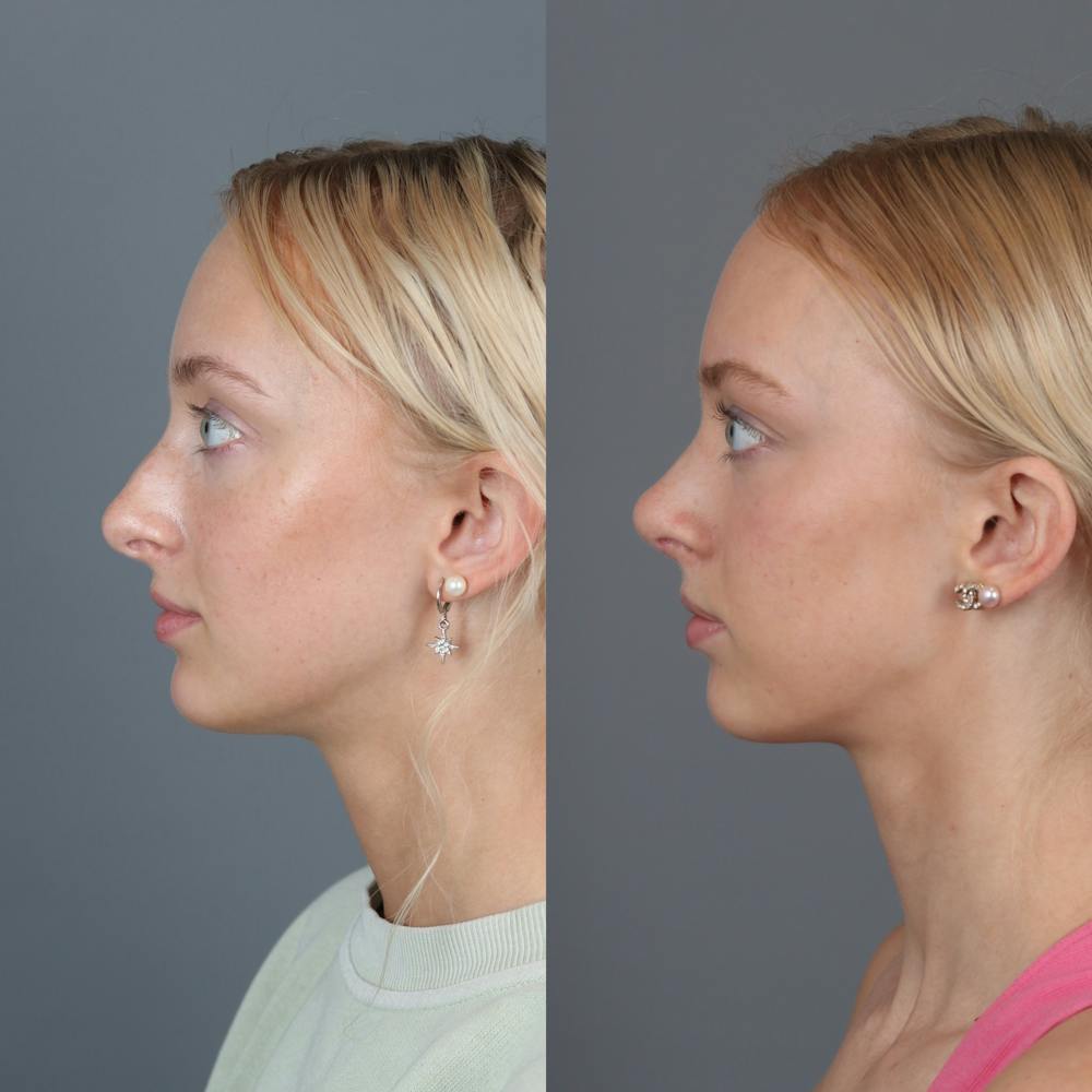 Rhinoplasty Before & After Gallery - Patient 123430792 - Image 4