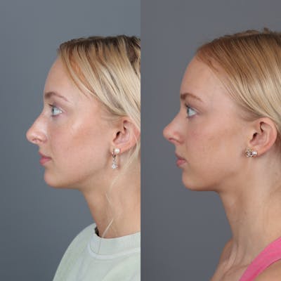 Rhinoplasty Before & After Gallery - Patient 123430792 - Image 4
