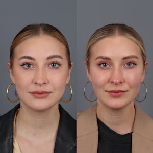 Buccal Fat Removal