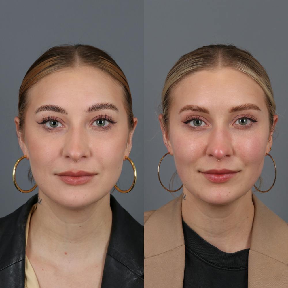 Buccal Fat Removal Before & After Gallery - Patient 142815061 - Image 1