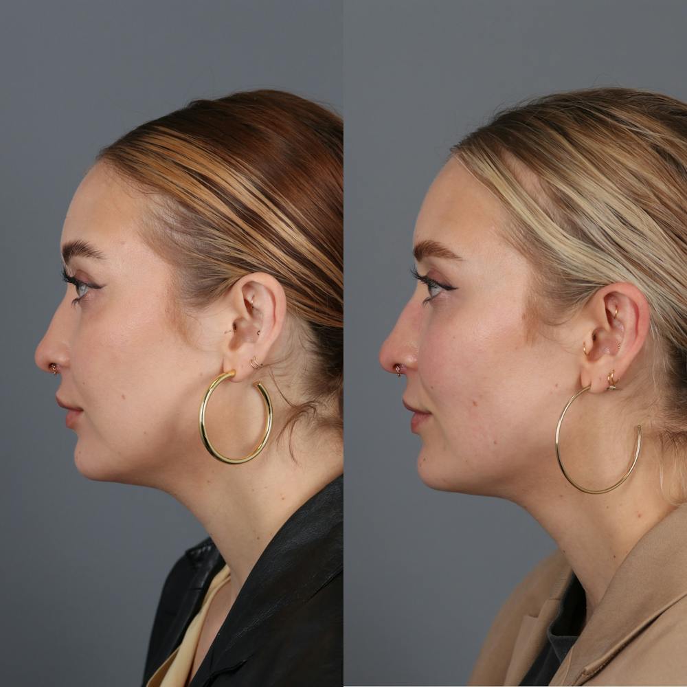 Buccal Fat Removal Before & After Gallery - Patient 142815061 - Image 3