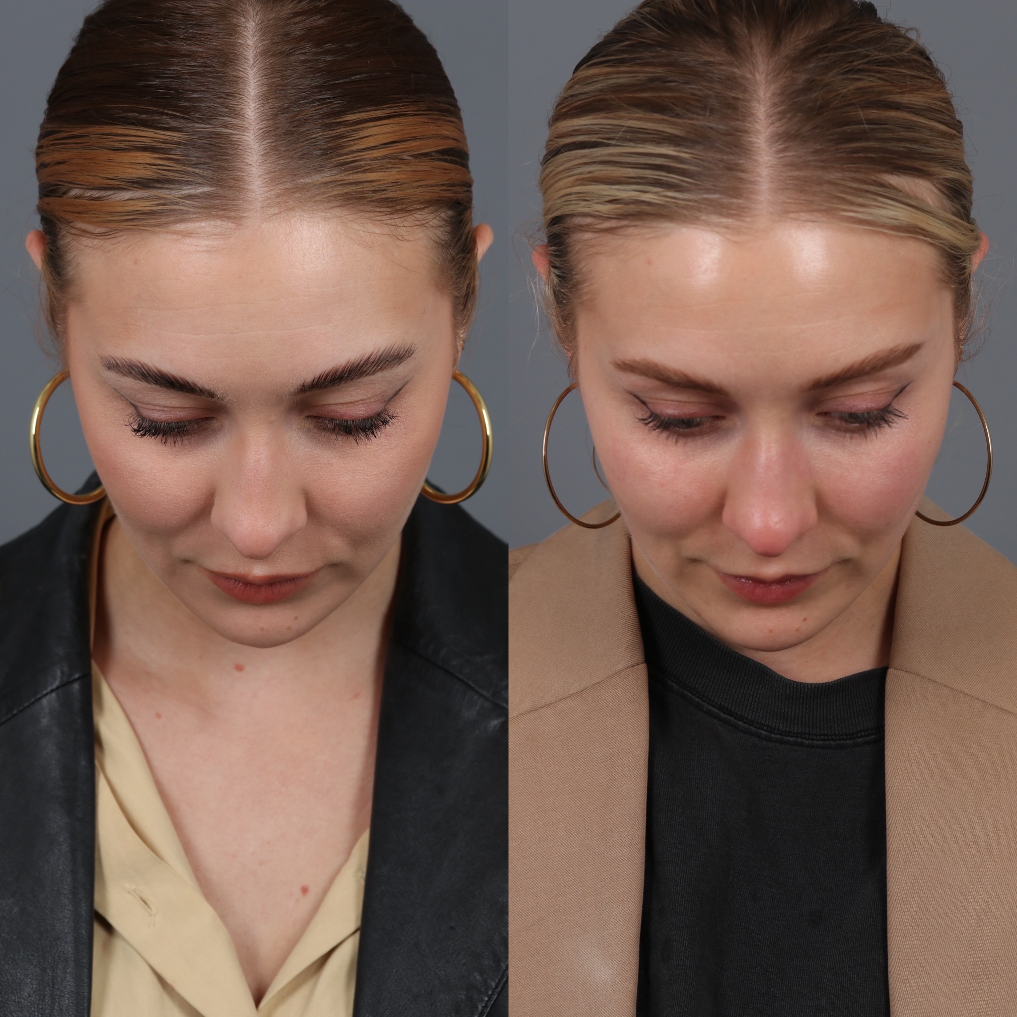 Patient 142815061 Buccal Fat Removal Before & After Photos The Vila Institute for Plastic