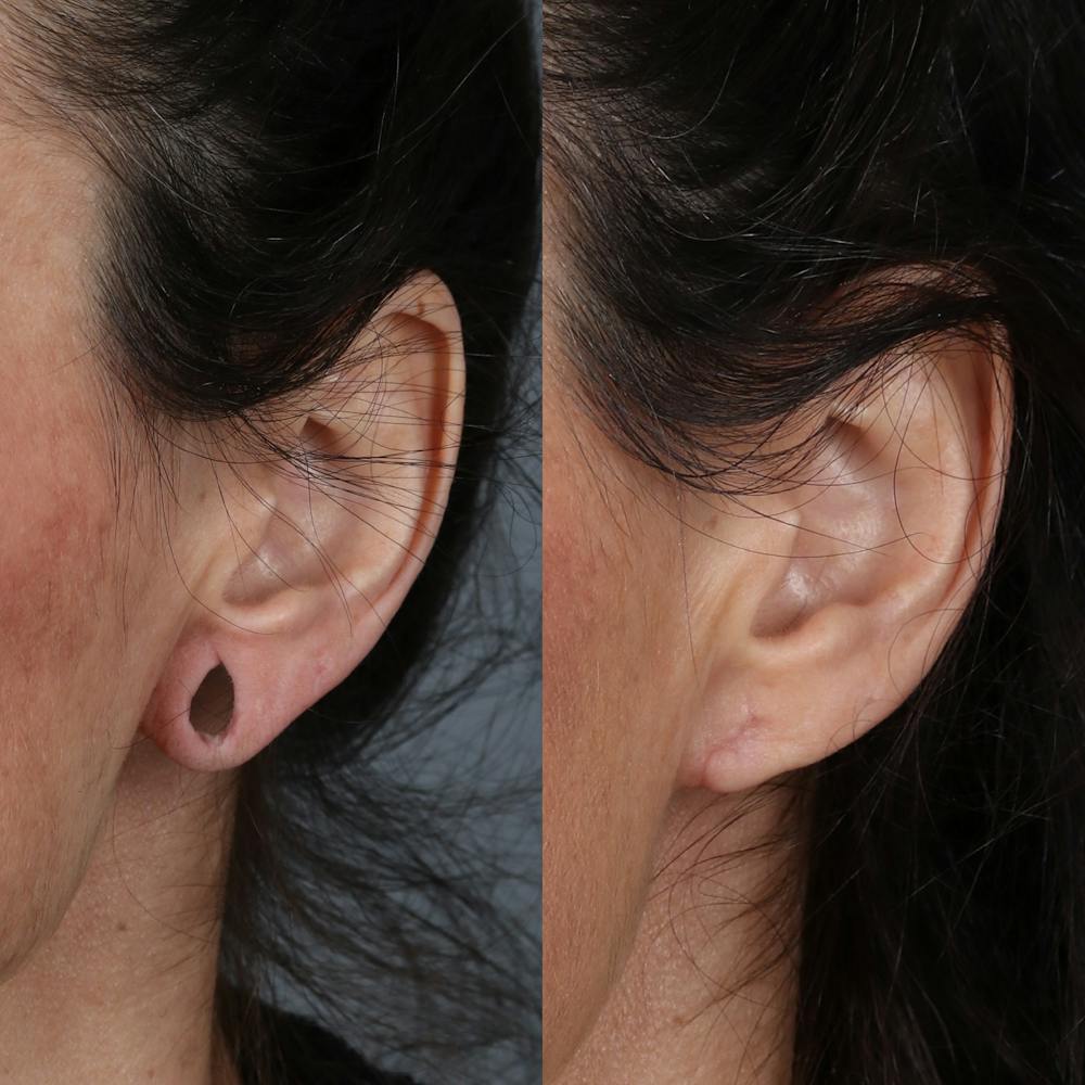 Earlobe Repair Before & After Gallery - Patient 142815063 - Image 1