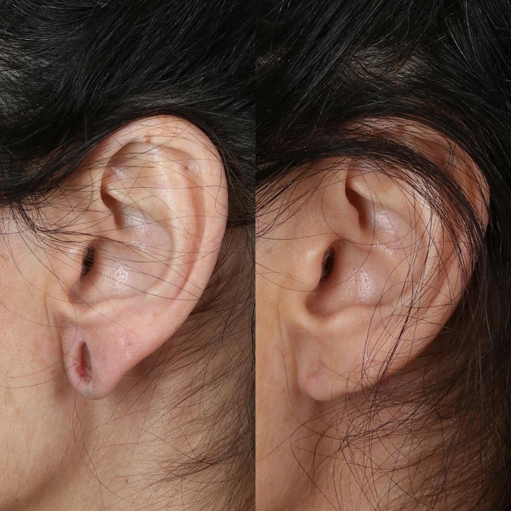 Earlobe Repair Before & After Gallery - Patient 142815063 - Image 2