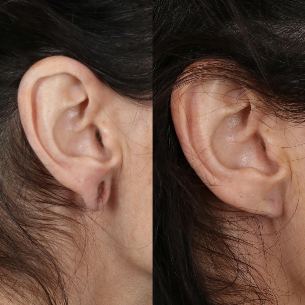 Earlobe Repair Before & After Gallery - Patient 142815063 - Image 3