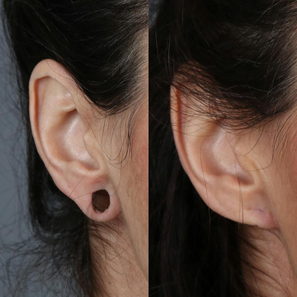 Earlobe Repair Before & After Gallery - Patient 142815063 - Image 4