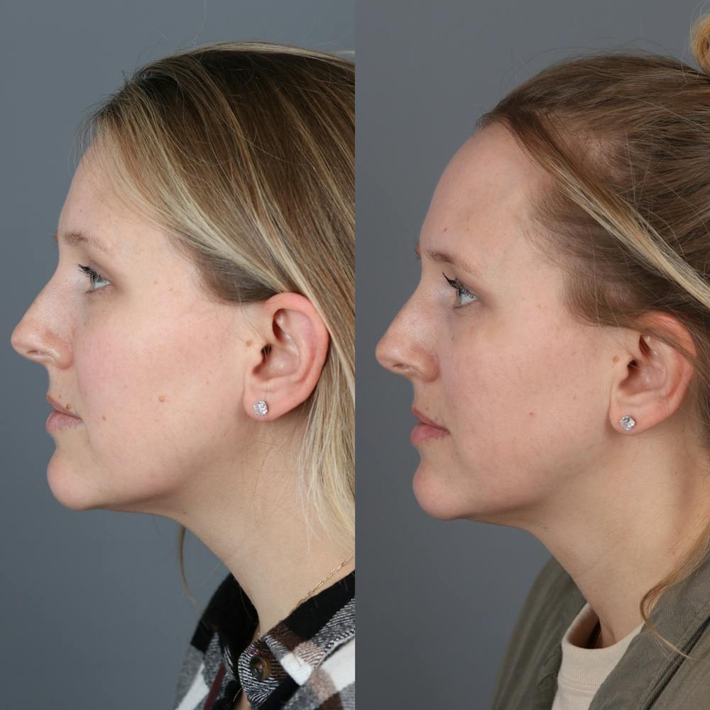 Laser Skin Resurfacing Before & After Gallery - Patient 142815079 - Image 3