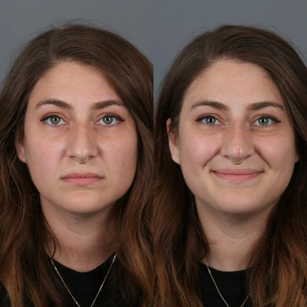 Liquid Rhinoplasty Before & After Gallery - Patient 142815092 - Image 3
