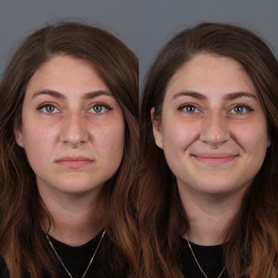 Liquid Rhinoplasty Before & After Gallery - Patient 142815092 - Image 1