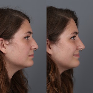 Non-Surgical Rhinoplasty in Portland Before & After Photos by Dr. Vila