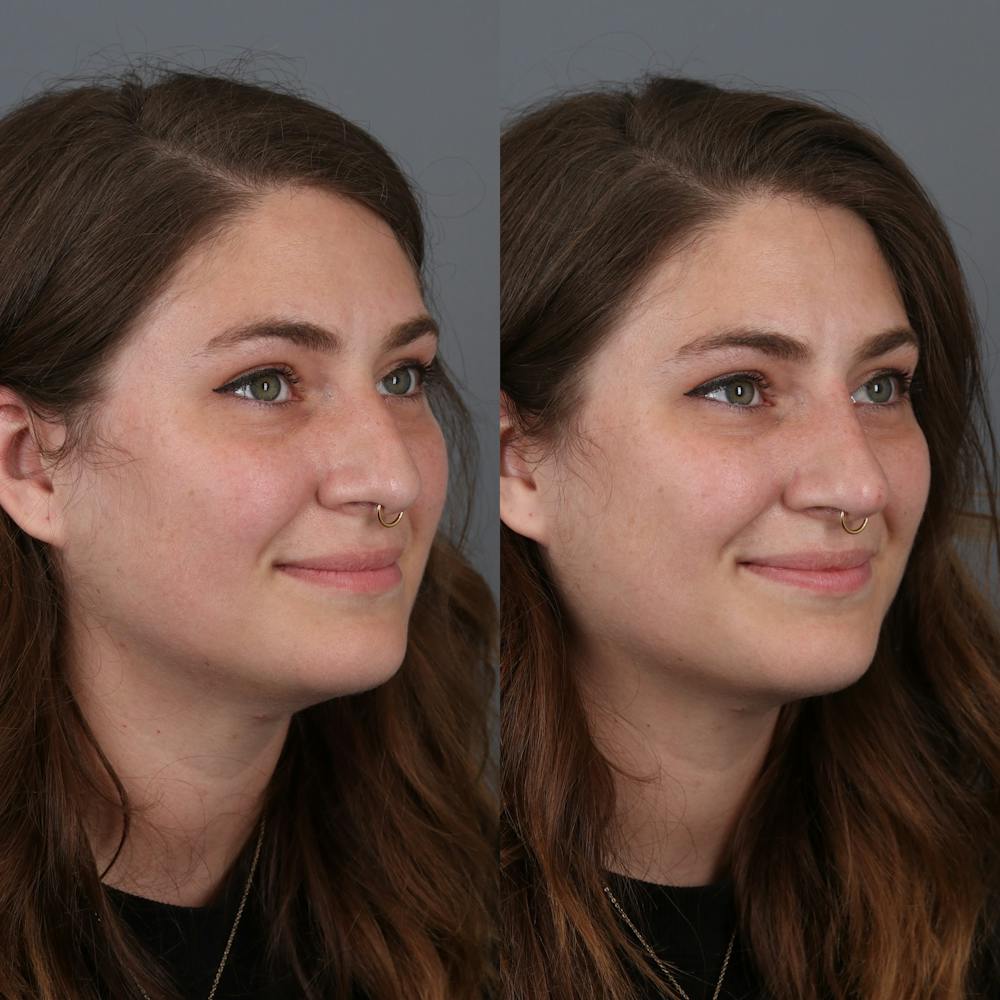 Liquid Rhinoplasty Before & After Gallery - Patient 142815092 - Image 2