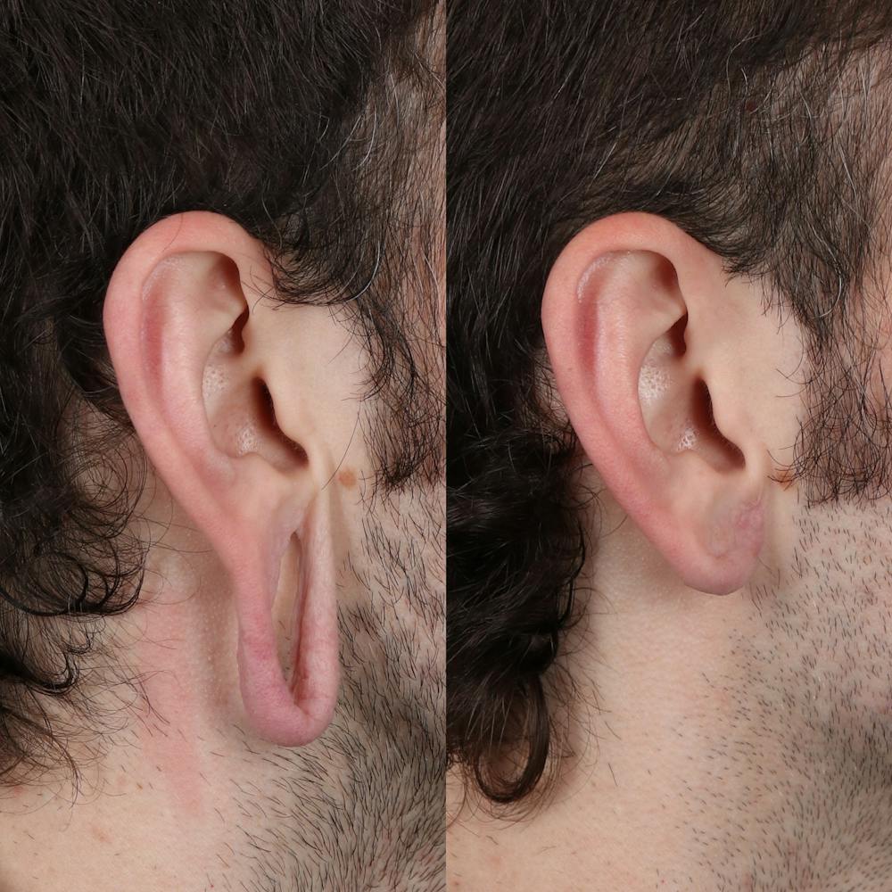 Earlobe Repair Before & After Gallery - Patient 143035185 - Image 3