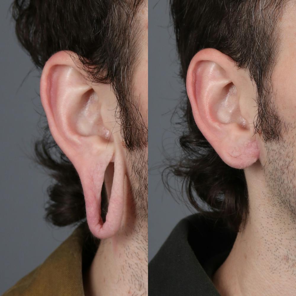 Earlobe Repair Before & After Gallery - Patient 143035185 - Image 4