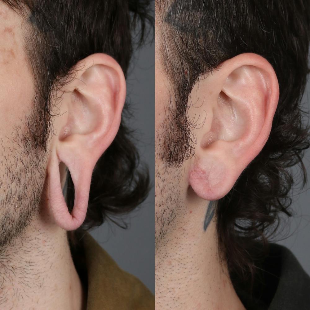 Earlobe Repair Before & After Gallery - Patient 143035185 - Image 2