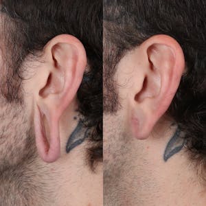 Earlobe Fillers Plastic Surgery Trend