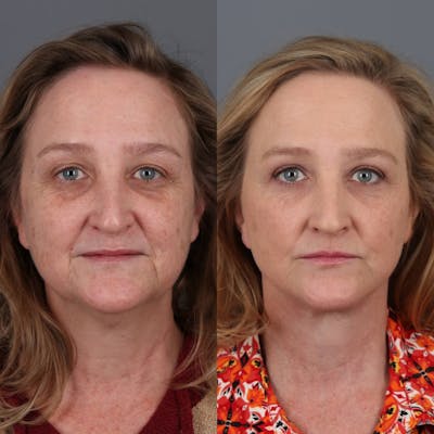 Face & Neck Lift Before & After Gallery - Patient 143801438 - Image 1