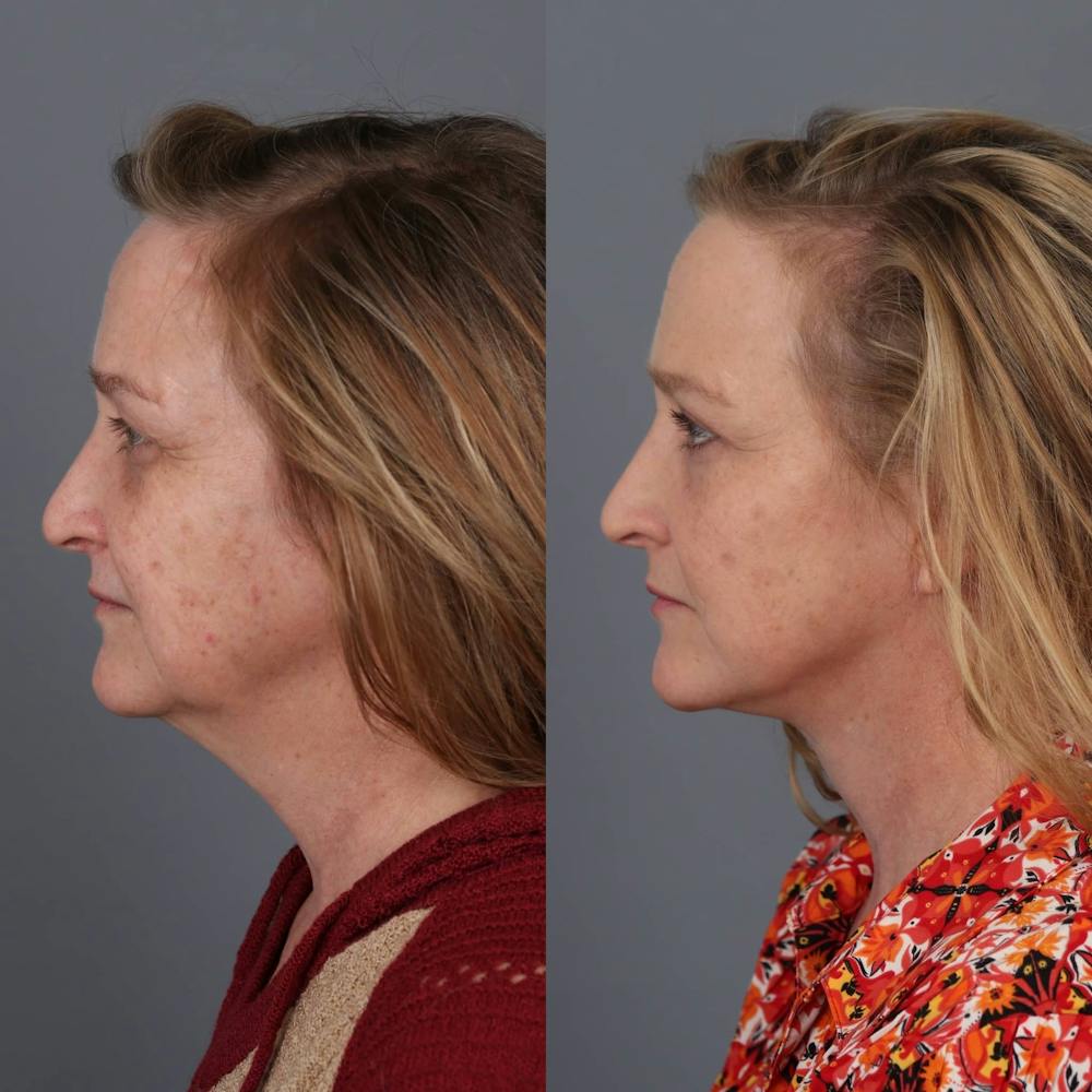 Facelift Before & After Gallery - Patient 143801438 - Image 3