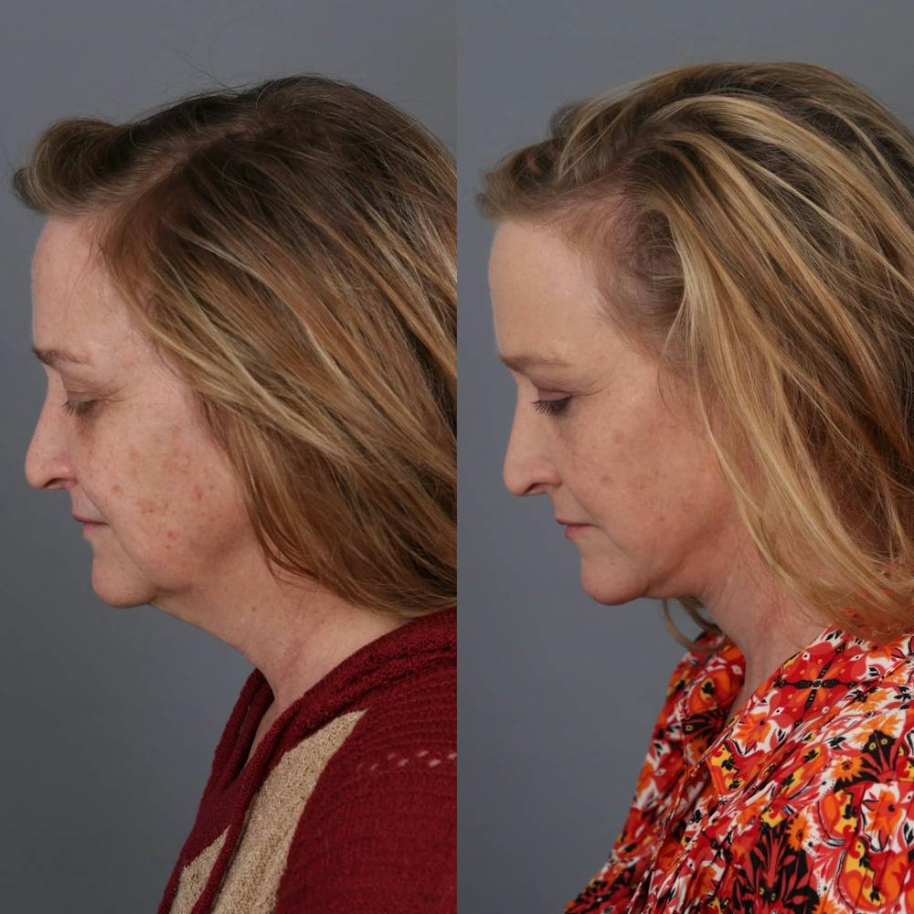 Face & Neck Lift Before & After Gallery - Patient 143801438 - Image 3