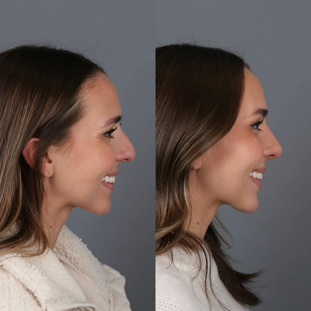 Rhinoplasty Before & After Gallery - Patient 143801767 - Image 1