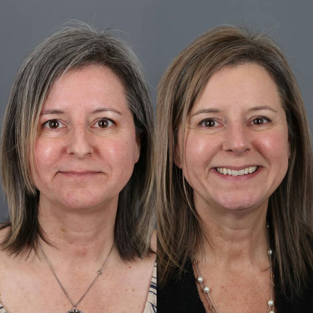 Rhinoplasty Before & After Gallery - Patient 143801768 - Image 2