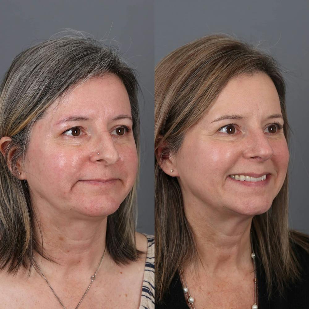 Rhinoplasty Before & After Gallery - Patient 143801768 - Image 3