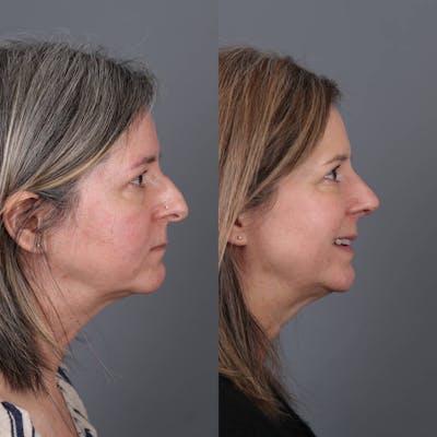 Rhinoplasty Before & After Gallery - Patient 143801768 - Image 1