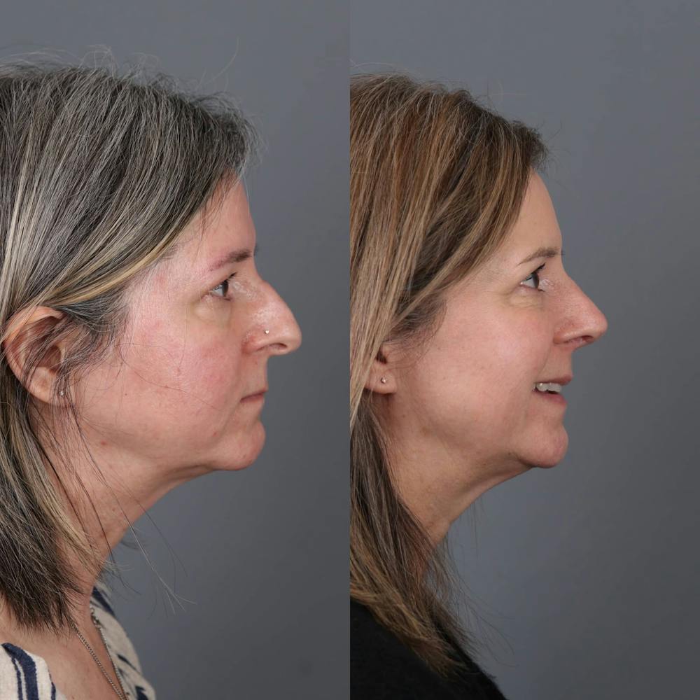 Rhinoplasty Before & After Gallery - Patient 143801768 - Image 3