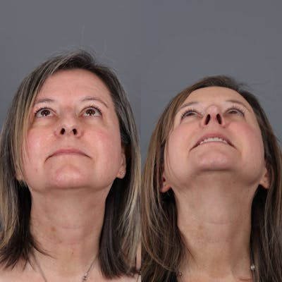 Rhinoplasty Before & After Gallery - Patient 143801768 - Image 4