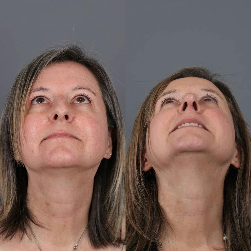 Rhinoplasty Before & After Gallery - Patient 143801768 - Image 4